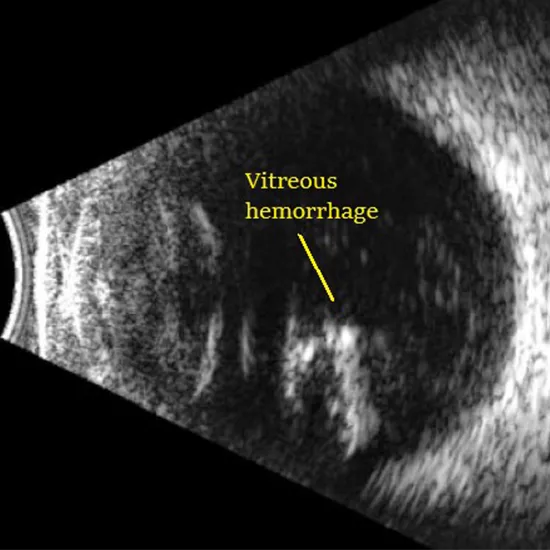 Bright Scan Ultrasound (B Scan) Procedure
